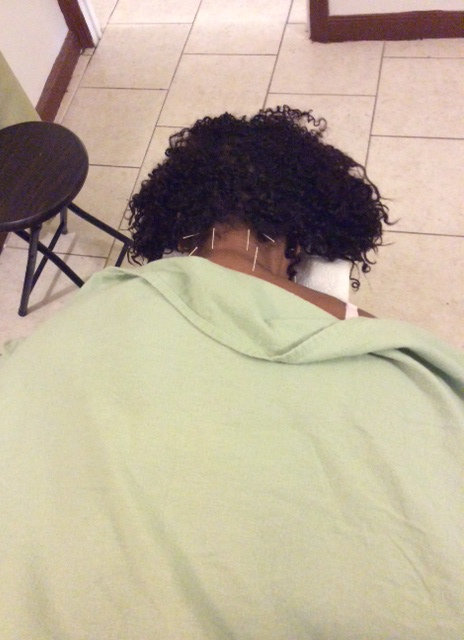 Jasmine Sanders gets acupuncture treatment.