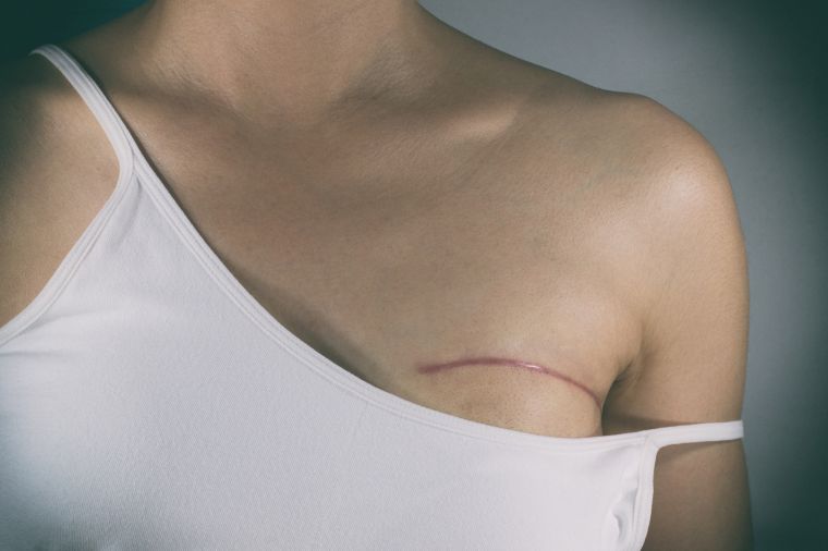 Myth: You can’t get cancer after a mastectomy