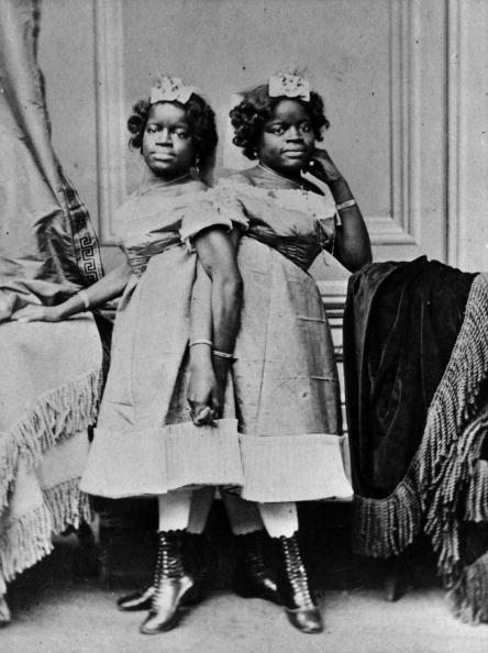 Millie and Christine McKoy (Siamese Twins)