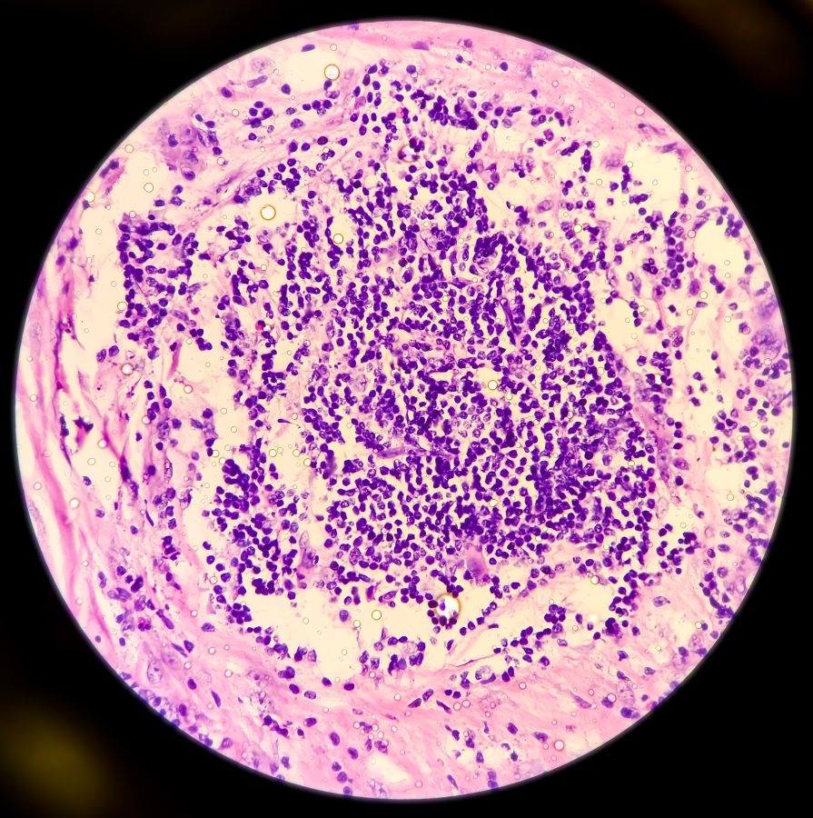 Microscopic image of Hidradenitis suppurativa in axillary mass tissues. showing hyperplasia of follicular epithelium, dermal inflammatory cell infiltrate present