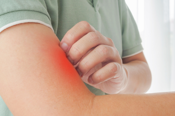 Young asian man itching and scratching on arm from itchy dry skin eczema dermatitis